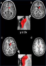 Investigadores del IMIM referentes mundiales en la investigación en Neuroimagen y TDAH